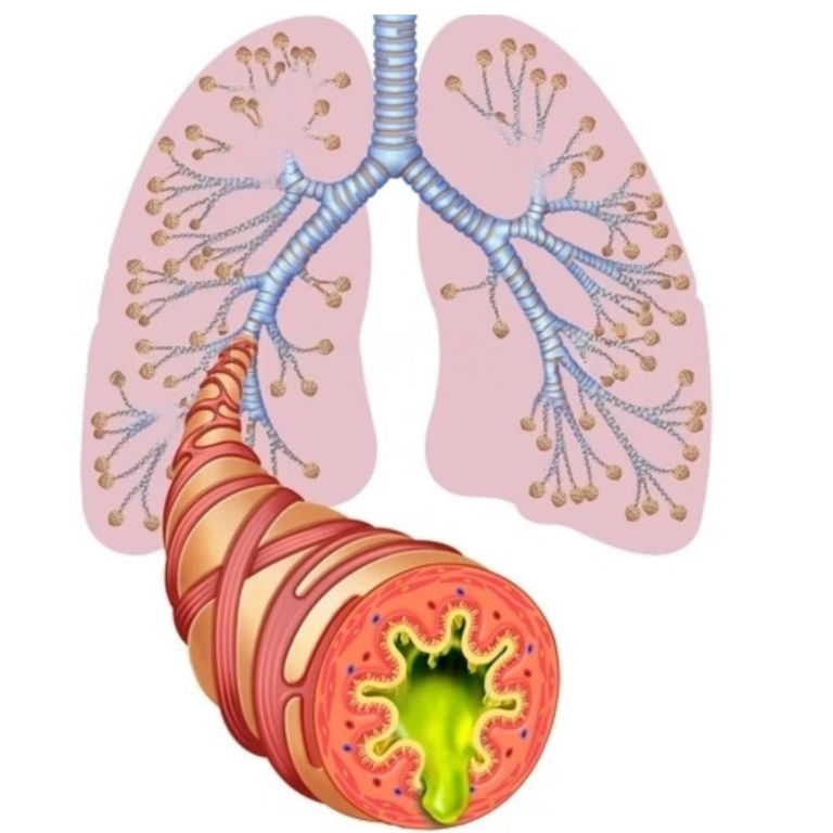 bronchitis disorder