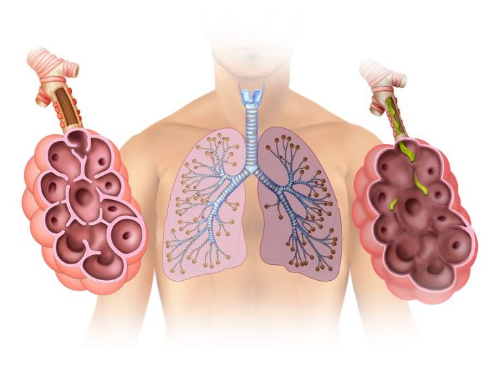 bronchitis disorder