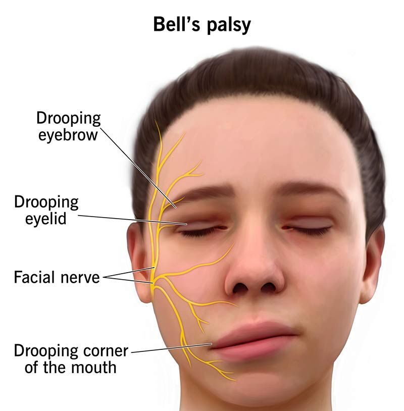 Bells Palsy