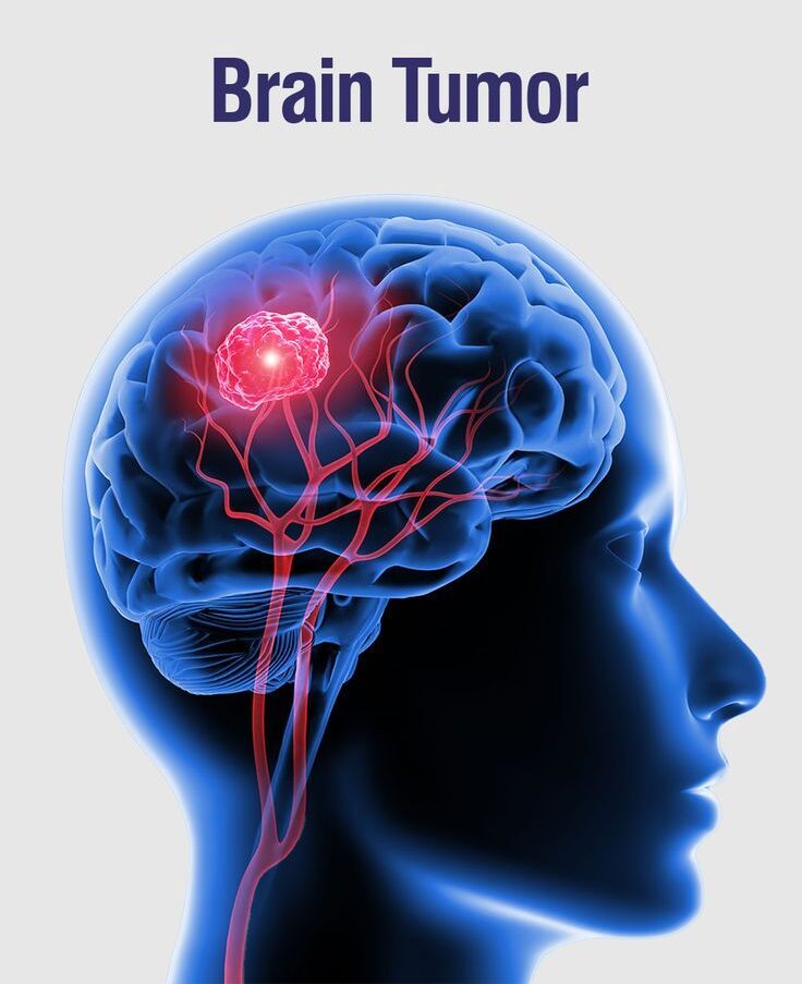Brain Tumor