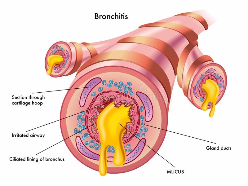 Natural Breathing Relief Products (brounchitis)