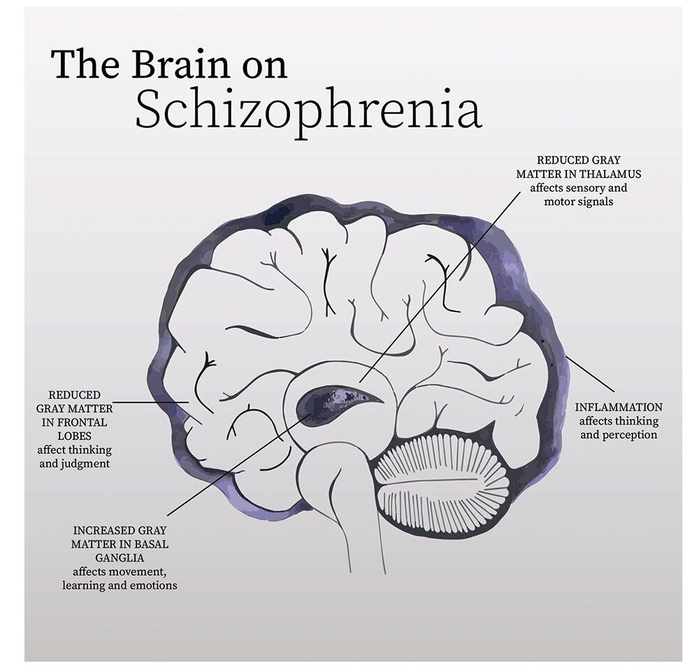 Schizophrenia