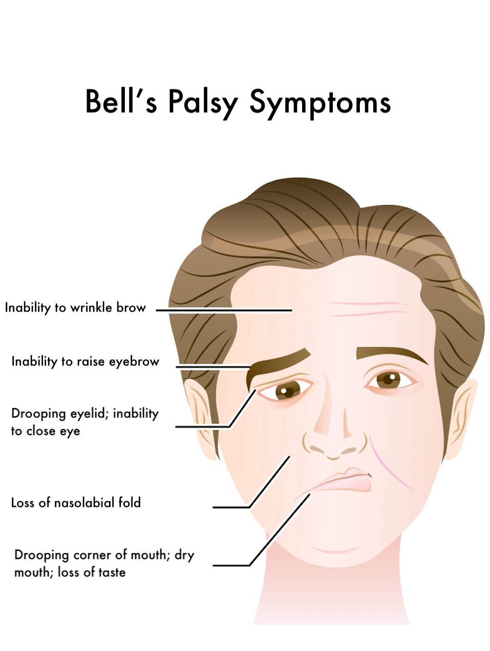 Neurological disorder therapy in Lucknow (what is bells palsy)
