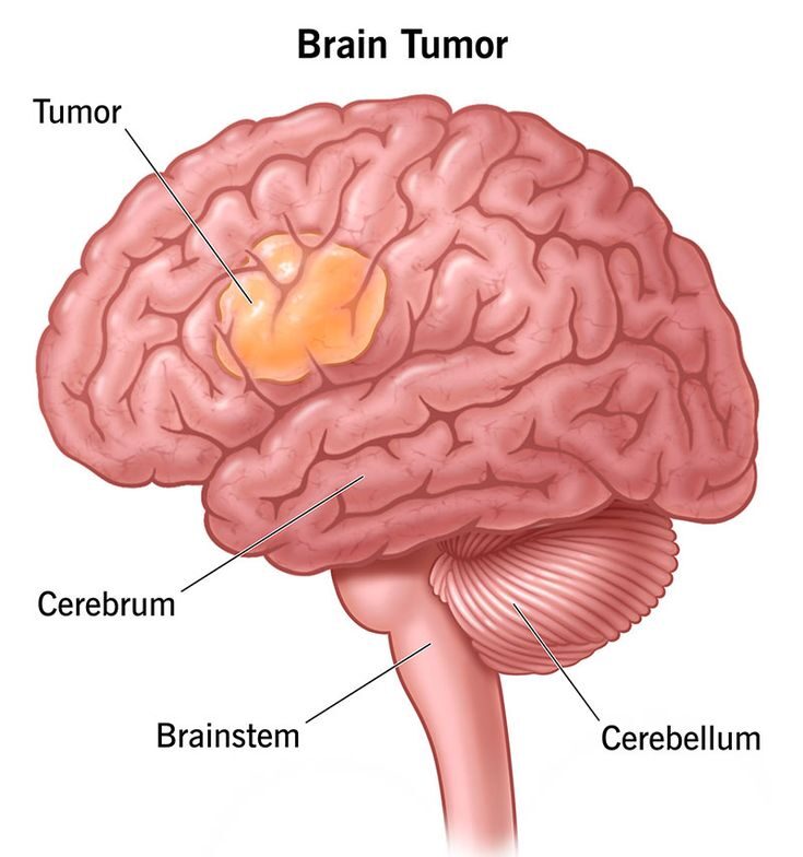 Neurological disorder therapy in Lucknow (brain tumor)